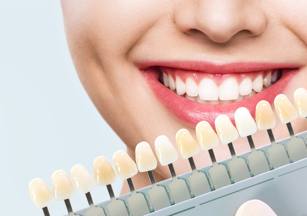 Natural-Looking Veneers for a Perfect Smile Natural-Looking Veneers for a Perfect Smile