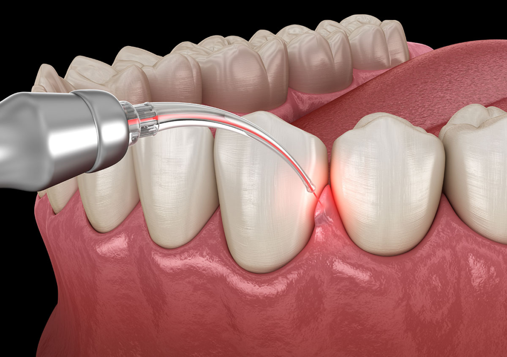 Complete Guide to LANAP Laser Treatment Procedure Complete Guide to LANAP Laser Treatment Procedure